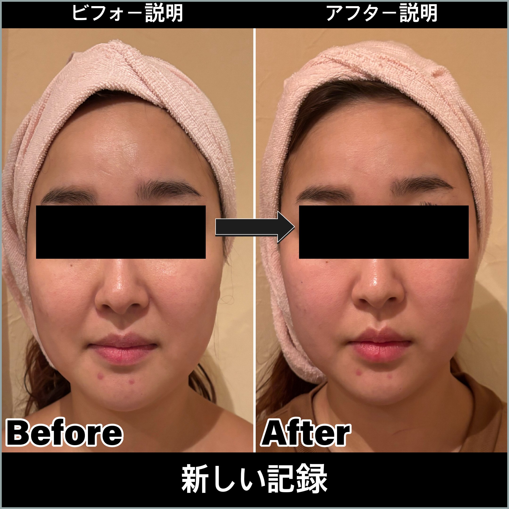 小顔・肌質改善ビフォーアフター