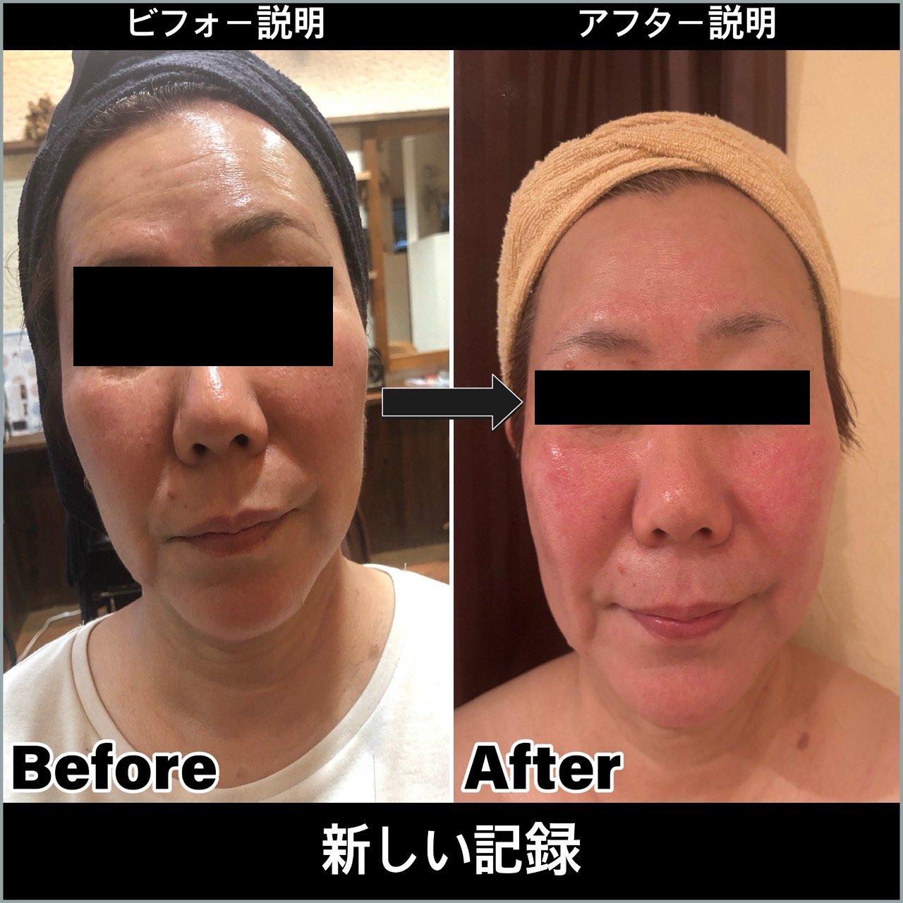 小顔・肌質改善ビフォーアフター